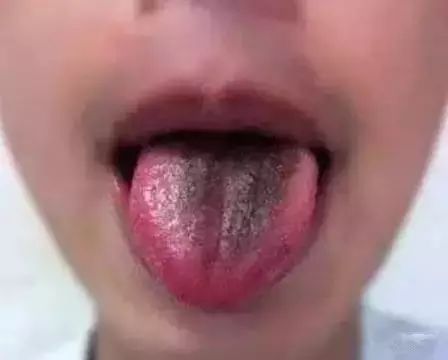舌头，一旦出现这个信号，马上去医院！