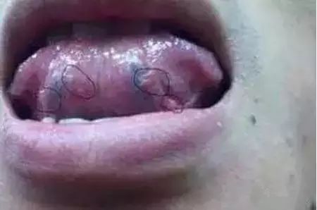 舌头，一旦出现这个信号，马上去医院！