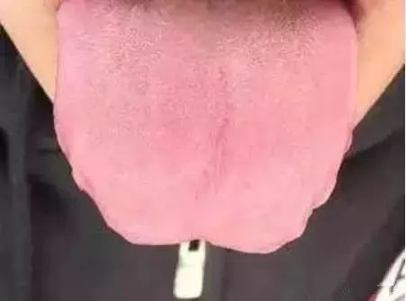 舌头，一旦出现这个信号，马上去医院！