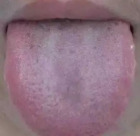 舌头，一旦出现这个信号，马上去医院！