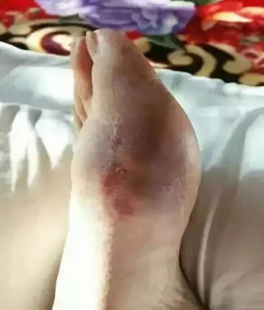 二十年的老痛风，痛风石被溶化大量排出！