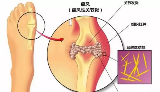 又到痛风高发季！民间土方连续吃7天，不出10天尿酸结晶没了！