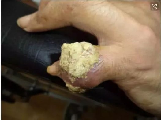 一种菜根是降尿酸的“高手”，每天泡水喝一点，治疗痛风很容易