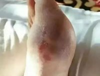 二十年的老痛风，痛风石被溶化大量排出！