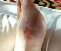 二十年的老痛风,痛风石被溶化大量排出!