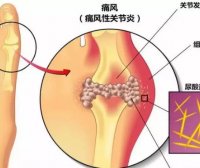 又到痛风高发季!民间土方连续吃7天,不出10天尿酸结晶没了!