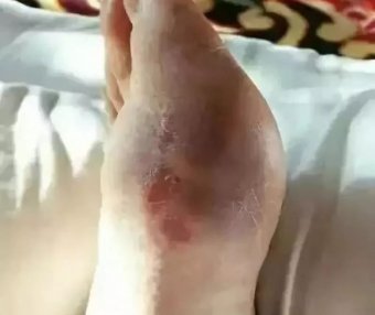 二十年的老痛风,痛风石被溶化大量排出!