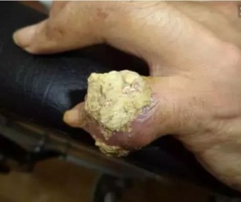 一种菜根是降尿酸的“高手”,每天泡水喝一点,治疗痛风很容易