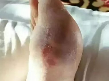 二十年的老痛风，痛风石被溶化大量排出！