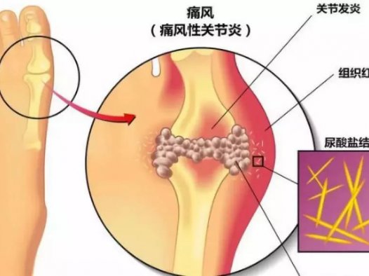 又到痛风高发季！民间土方连续吃7天，不出10天尿酸结晶没了！