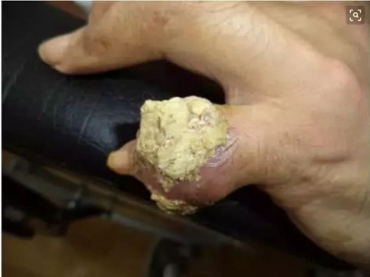 一种菜根是降尿酸的“高手”，每天泡水喝一点，治疗痛风很容易